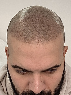 clinicas micropigmentacion en buenos aires Microscalp Buenos Aires-Solución Capilar-Micropigmentación Capilar
