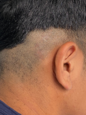 clinicas micropigmentacion en buenos aires Microscalp Buenos Aires-Solución Capilar-Micropigmentación Capilar