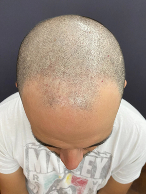 clinicas micropigmentacion en buenos aires Microscalp Buenos Aires-Solución Capilar-Micropigmentación Capilar