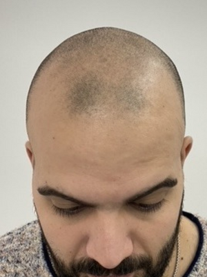 clinicas micropigmentacion en buenos aires Microscalp Buenos Aires-Solución Capilar-Micropigmentación Capilar