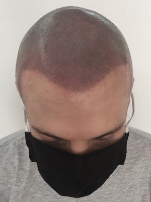 clinicas micropigmentacion en buenos aires Microscalp Buenos Aires-Solución Capilar-Micropigmentación Capilar