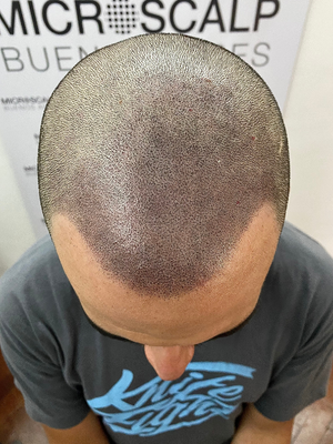clinicas micropigmentacion en buenos aires Microscalp Buenos Aires-Solución Capilar-Micropigmentación Capilar