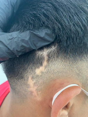 clinicas micropigmentacion en buenos aires Microscalp Buenos Aires-Solución Capilar-Micropigmentación Capilar