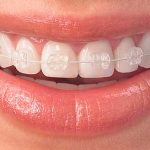 clinicas ortodoncia buenos aires DentalSi, Ortodoncía, Odontologia, Brackets