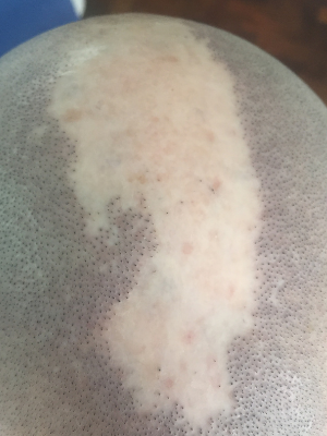 clinicas micropigmentacion en buenos aires Microscalp Buenos Aires-Solución Capilar-Micropigmentación Capilar