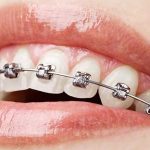clinicas ortodoncia buenos aires DentalSi, Ortodoncía, Odontologia, Brackets